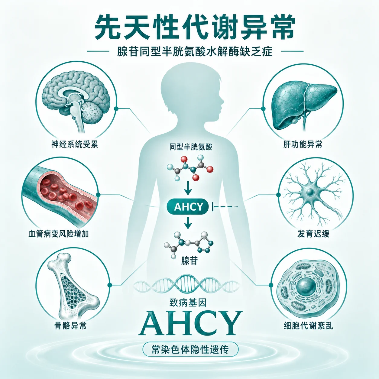 S- 腺苷高半胱氨酸水解酶缺乏型高甲硫氨酸血症 - 遗传代谢病示意图