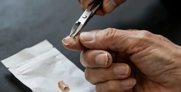 昭通亲子鉴定指甲样本采集